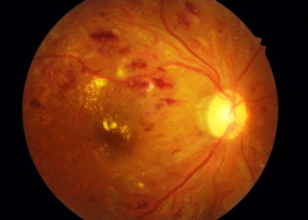 視網膜出血及水腫。