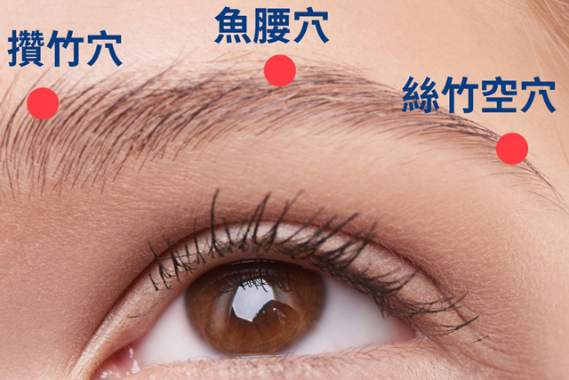 乾眼症患者每天用4次「人工淚液」 中醫針灸改善依賴 針灸眼周攢竹、魚腰、絲竹空等穴位,舒緩眼部不適。