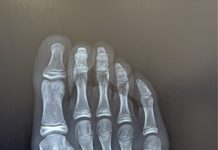 運動過度暗藏風險!小朋友腳痛恐是「應力性骨折」