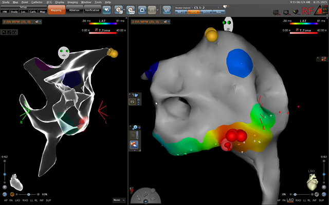 4歲就「心律不整」常掛急診!安南醫院兒童心臟科完成首例電燒手術 安南醫院兒童心臟科醫師吳承諭提醒,心律不整可能造成暈厥、心臟功能下降,甚至猝死。
